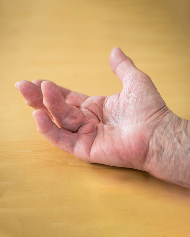 Dupuytren’s Contracture Surgery