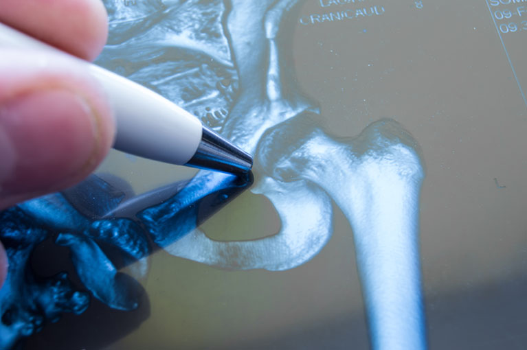 orthopaedics hip surgeries conditions diagram illustrated