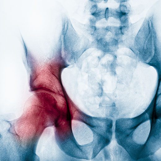 orthopaedics hip surgeries dysplasia xray pain