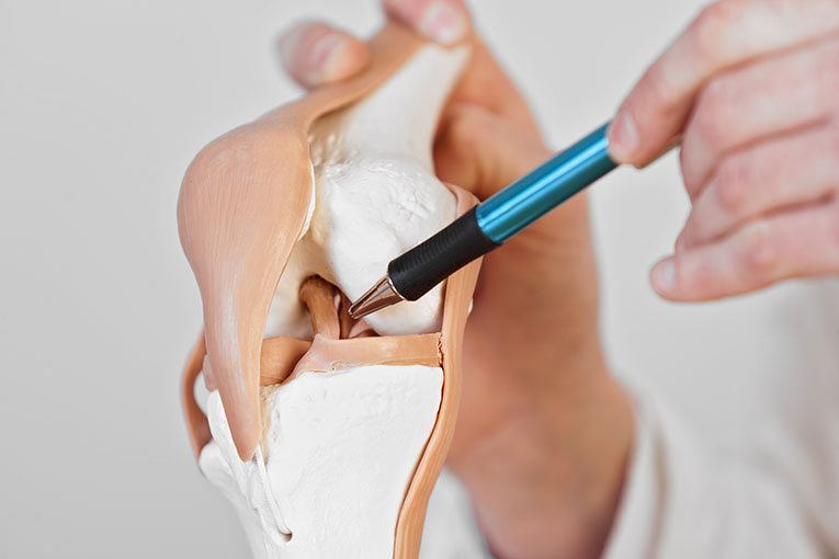 Meniscectomy model