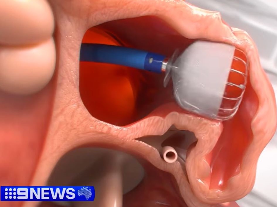 Implant device